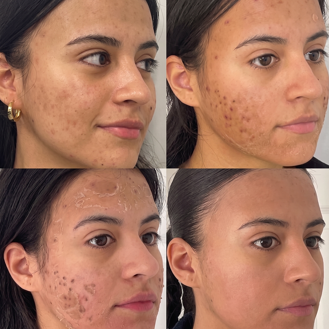 Chemical Peel