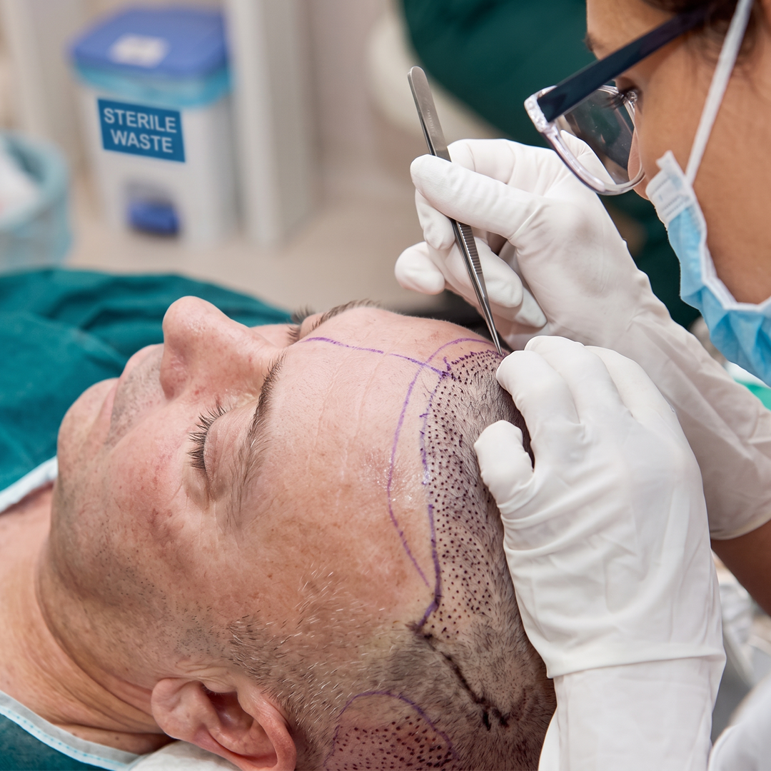 Hair Transplant