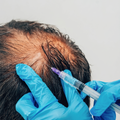 PRP Hair Treatment