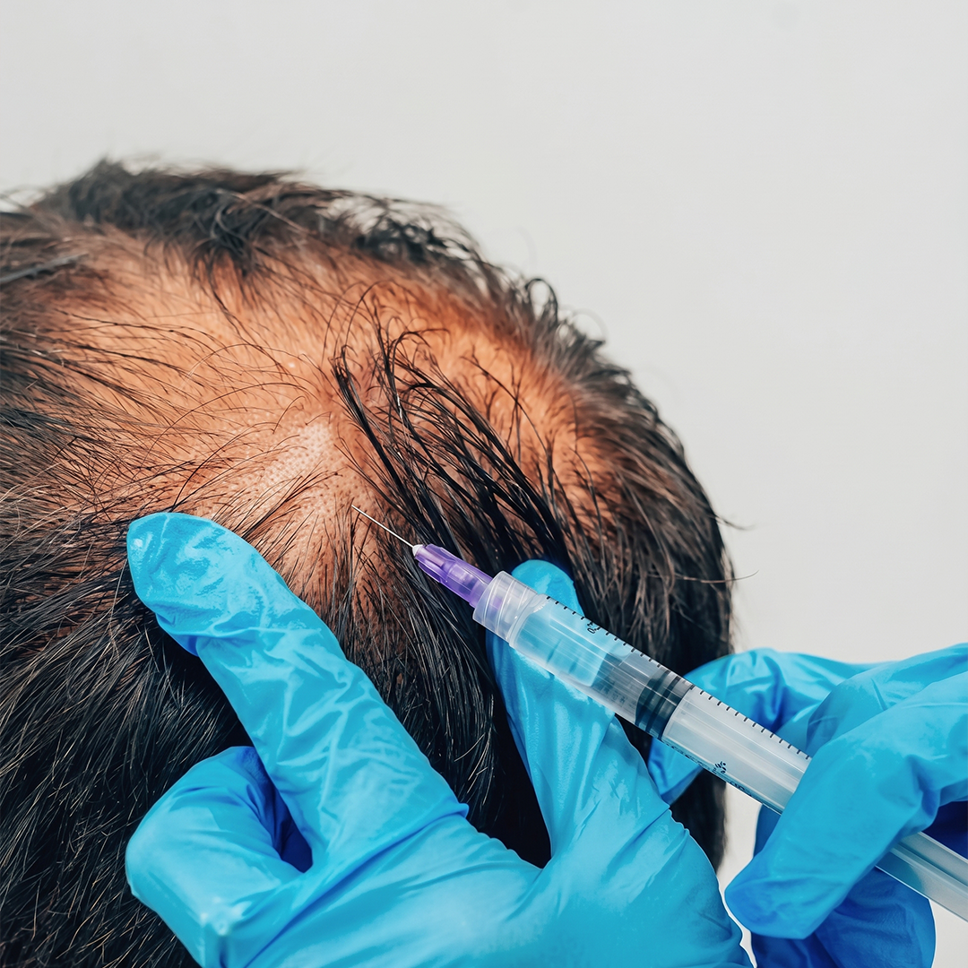 PRP Hair Treatment