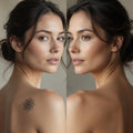 Tattoo Removal