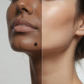 Warts and Tag Removal
