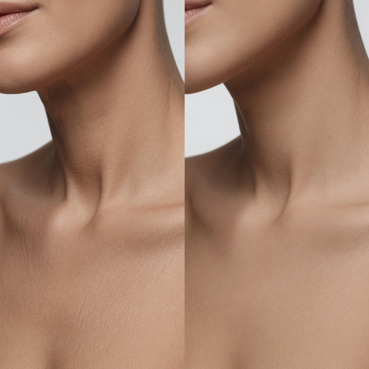 Microneedling