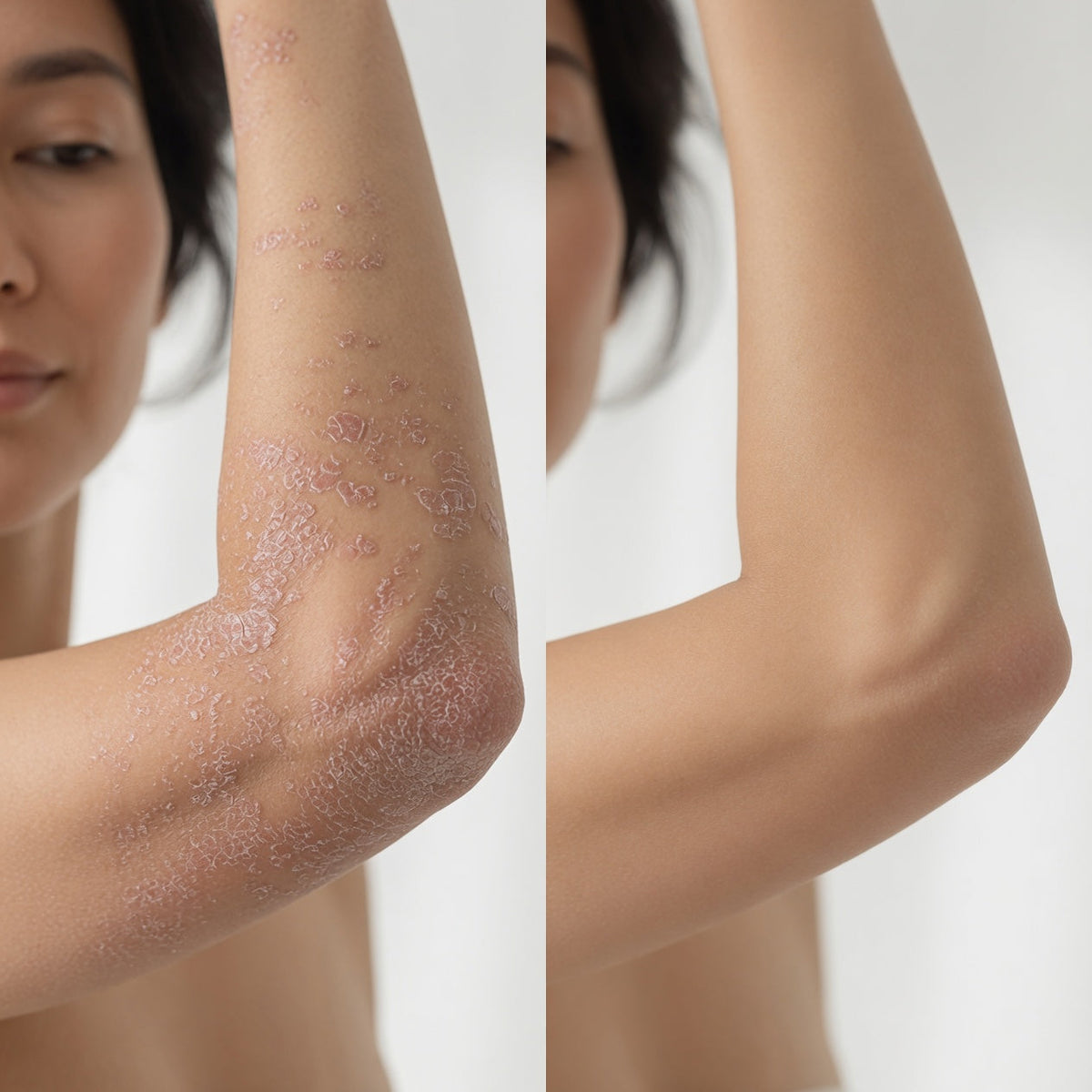 Psoriasis